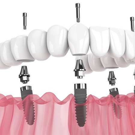 illustration of implant dentures