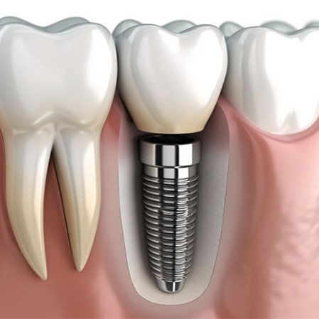 illustration of implant dentures