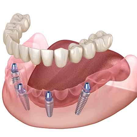illustration of implant dentures