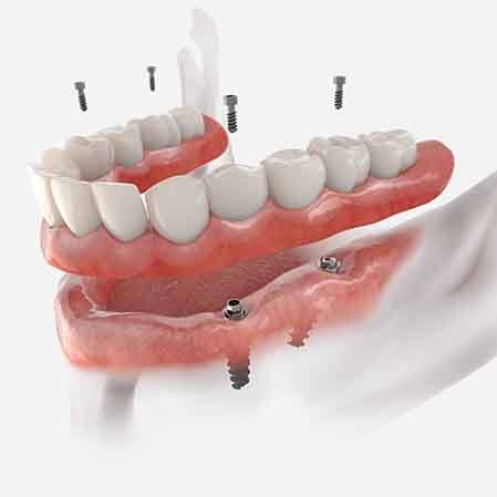 illustration of screws going into permanent implant dentures