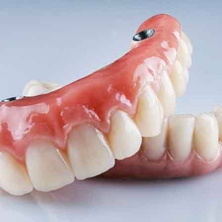 set of removable implant dentures on a counter