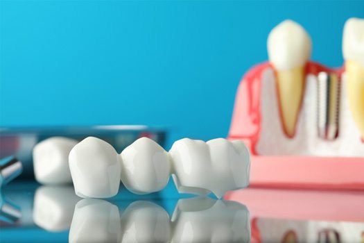 Dental bridge and model implants on reflective surface with light blue background
