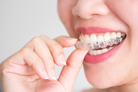 Nose-to-chin view of woman putting Invisalign over top teeth