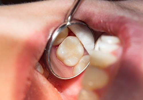 Closeup of dental mirror reflecting tooth-colored filling