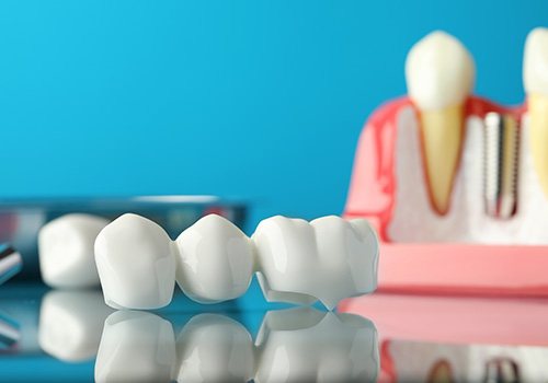 Dental bridge in front of an implant on a reflective surface