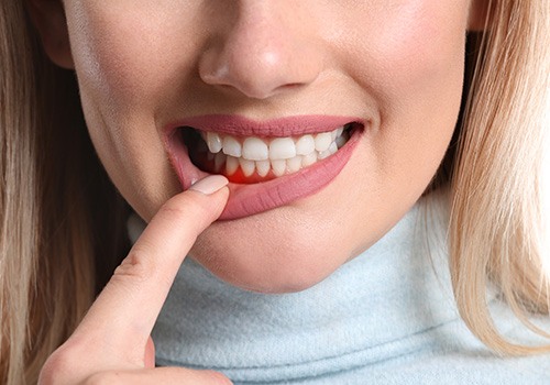 Woman pulling down her lower lip to reveal red gums