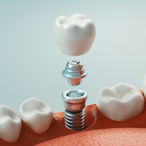 Illustration of single dental implant between natural teeth