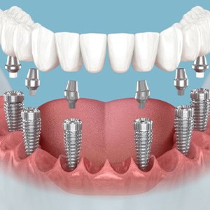 Illustration of implant denture for lower arch