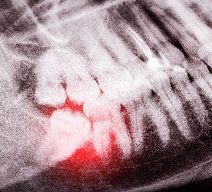 An X-ray of a wisdom tooth in San Antonio