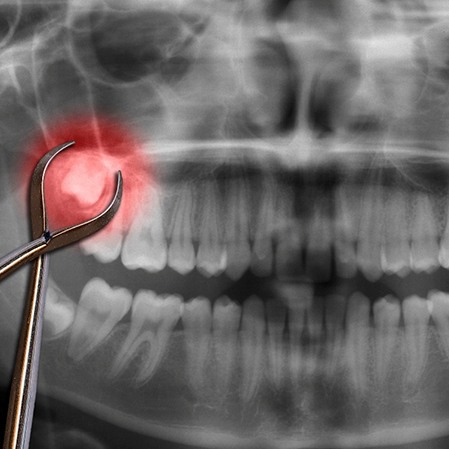 Image of a dental tool reaching for a wisdom tooth