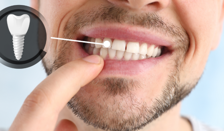 Man with dental implant