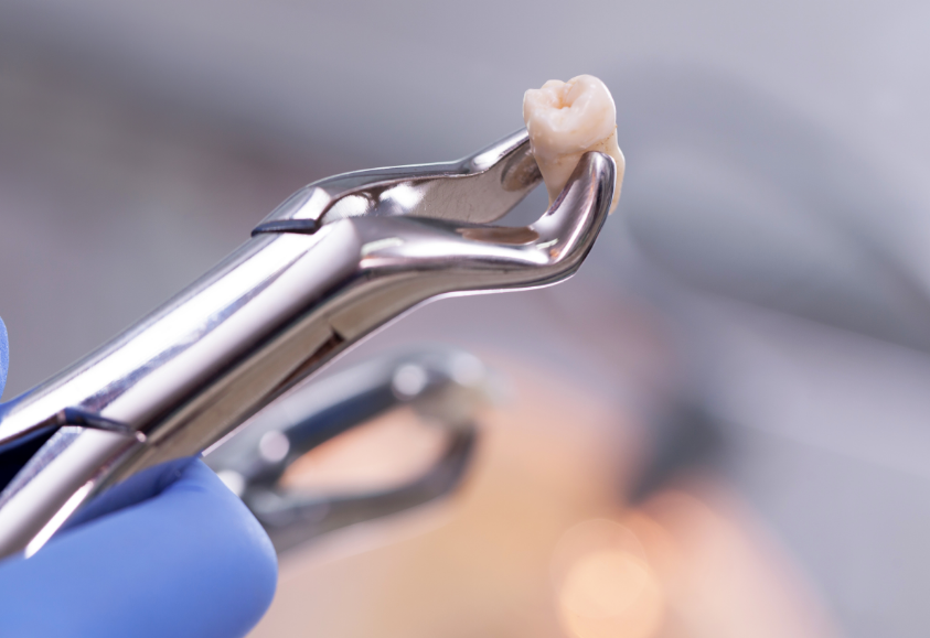 Extracted tooth on forceps