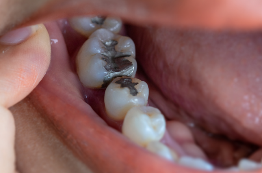 Close up of metal fillings